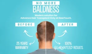New Touch – Hair Transplant Clinic