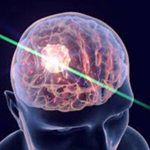 Best Neurosurgery Hospital in Chennai | Expert Neurosurgeon