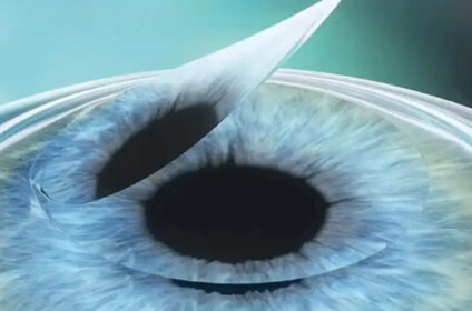 cataract surgery