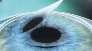 cataract surgery in mumbai