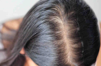 Best Hair Clinic in Noida by Alopecia Herbal Treatment