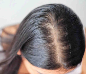 Best Hair Clinic in Noida by Alopecia Herbal Treatment