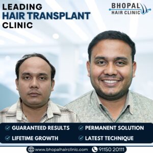 Bhopal Hair Clinic