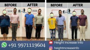 How Much Height Can You Gain with Limb Lengthening Surgery in India?
