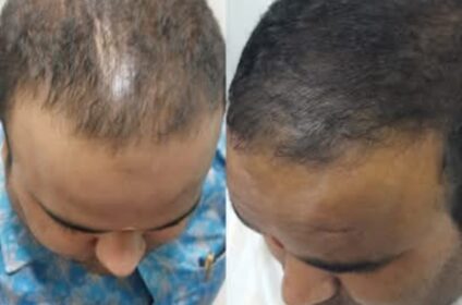 Consult an Experienced Hair Transplant Doctor