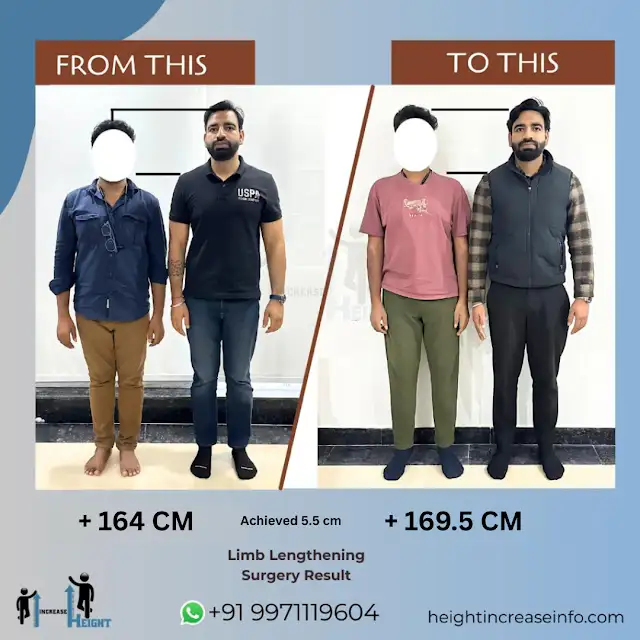 Tibia-Lengthening-Patient-Achieved-5.5-cm