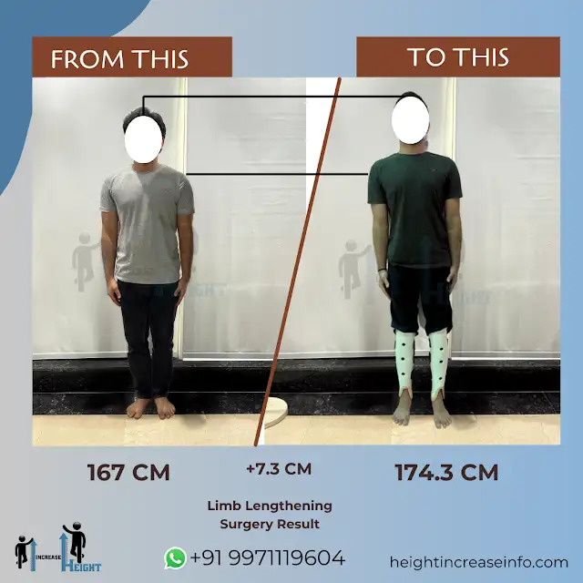 Tibia-Lengthening-Patient-Achieved-7.3-CM-Height