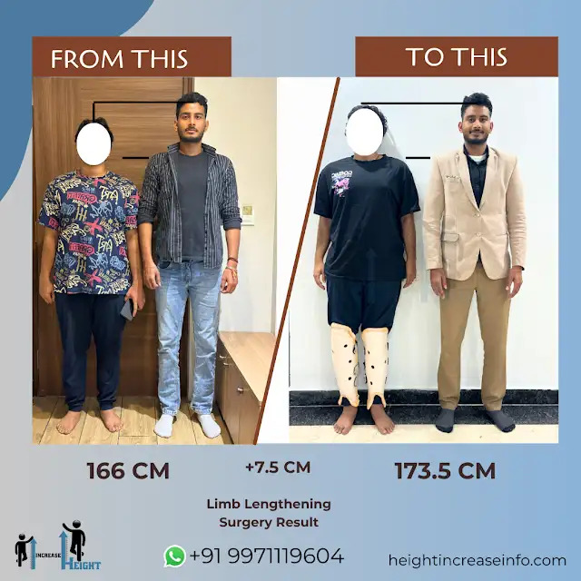 Tibia-lengthening-Patient-Achieved-7.5-CM-Height-with-Height-Increase-Info
