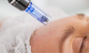 Ankita B Dhingra – Microneedling Treatment