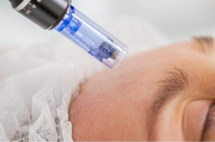 Ankita B Dhingra – Microneedling Treatment